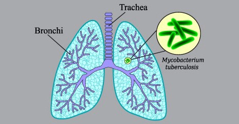 잠복결핵 양성 증상