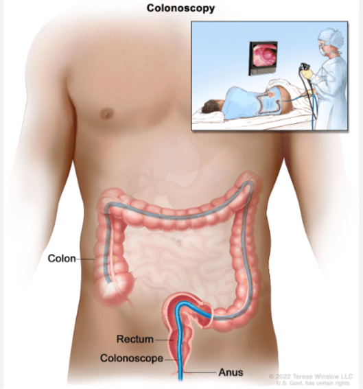 직장암 증상 초기 예방법