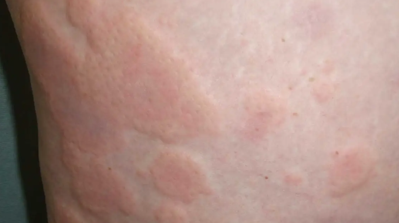 두드러기에 안좋은 음식