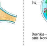 안압이 높아지는 이유 &mdash; 눈 속의 보이지 않는 압력
