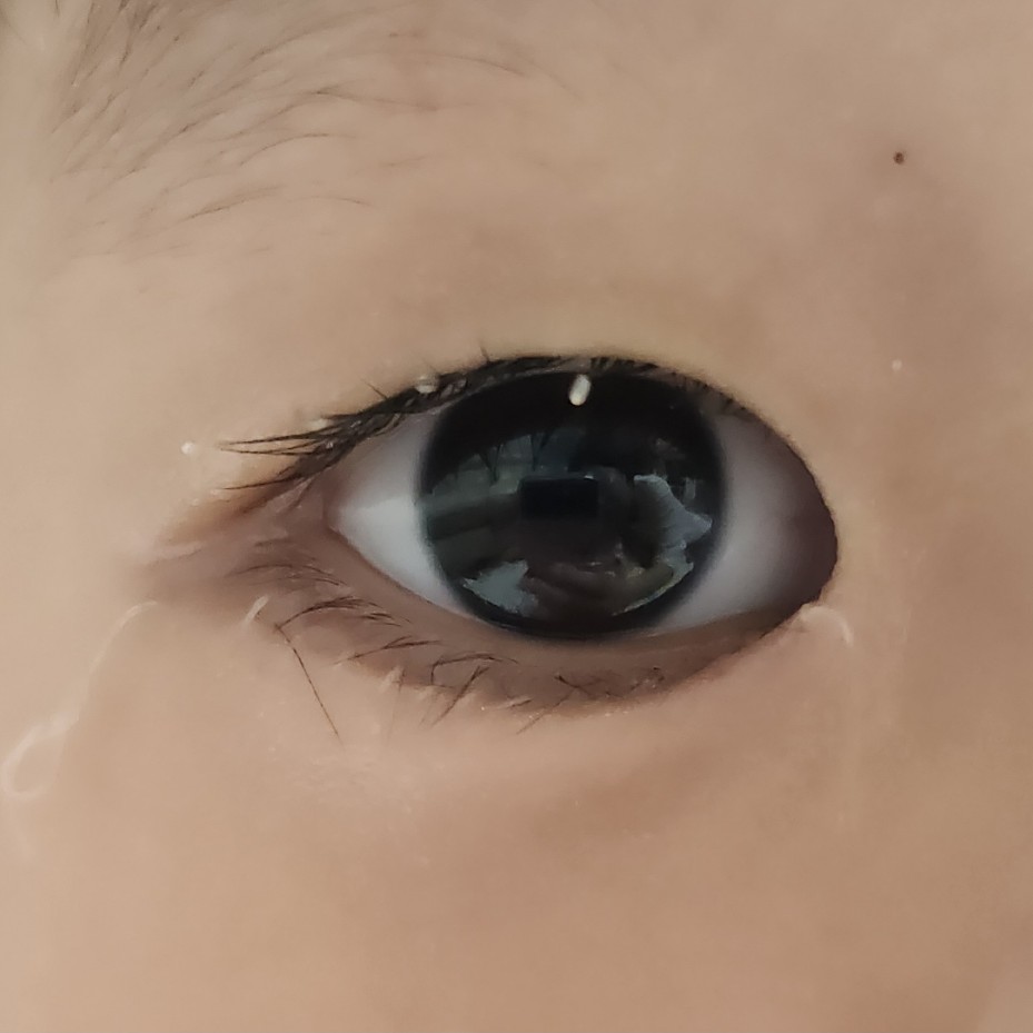 수술 8일 후 눈