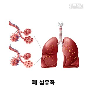 제한성 환기장애