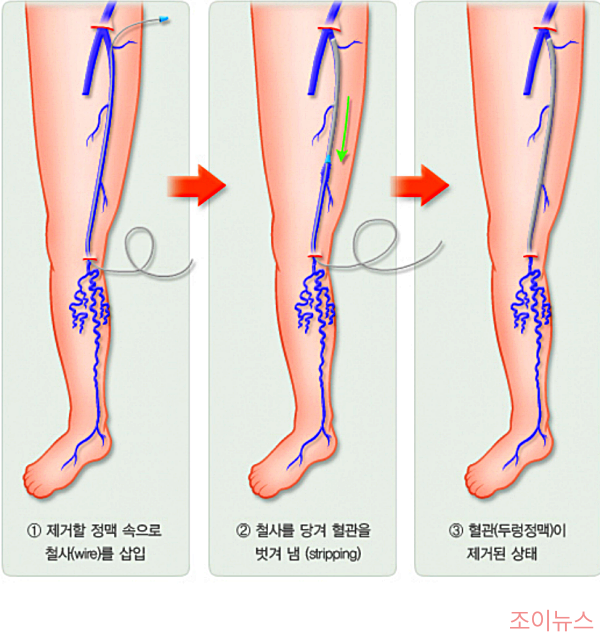 하지정맥류 수술치료법 중 두렁정맥 제거술_출처:국가건강정보포털