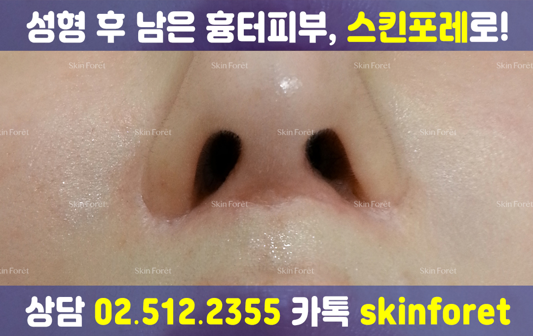 코 흉살과 수술흉터 전후, 쥬브젠 없이 개선된 모습