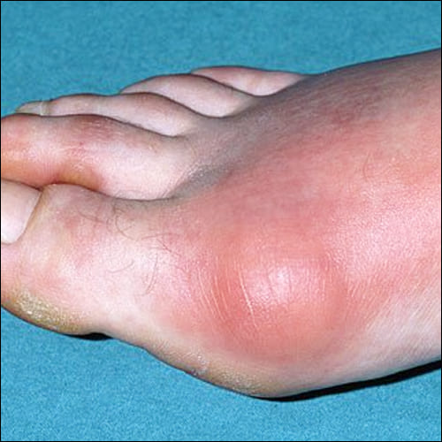 붉은 발적이 생긴 발의 옆모습