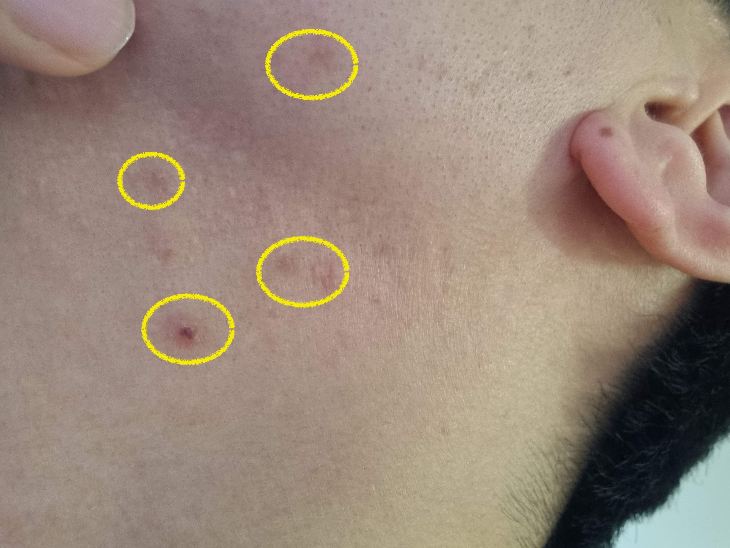 목드름 없애는법