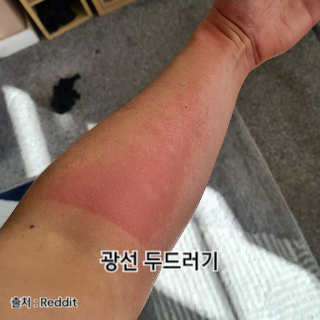 햇빛-알레르기-증상