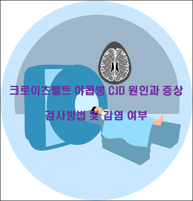 크로이츠펠트야콥병 CJD 원인과 증상 검사방법 및 감염 여부 썸네일 이미지