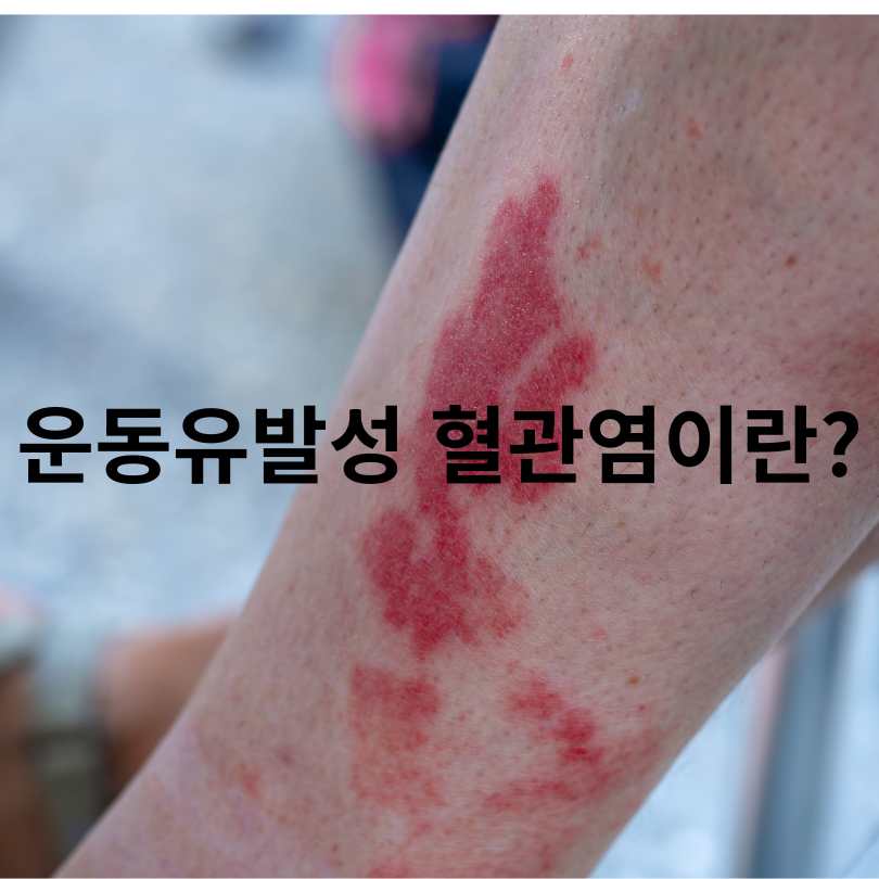 디즈니발진&amp;#44; 운동유발성 혈관염 원인&amp;#44; 증상&amp;#44;예방법