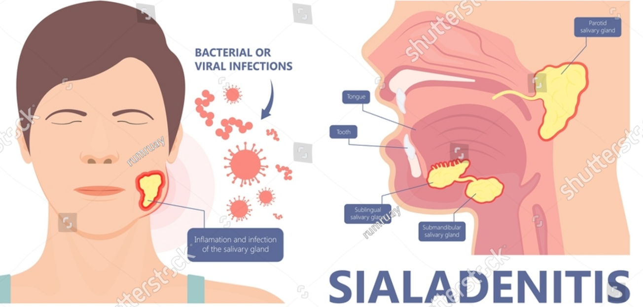 설암과 혀 절제술