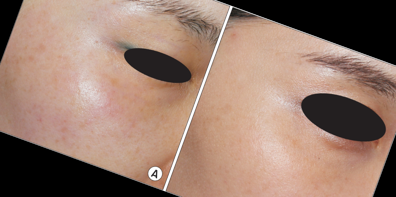 슈링크 부작용 효과 가격 후기