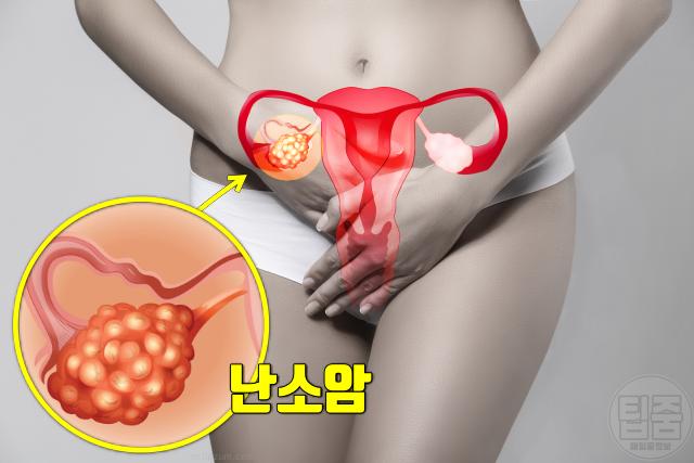 난소암 증상 전조증상