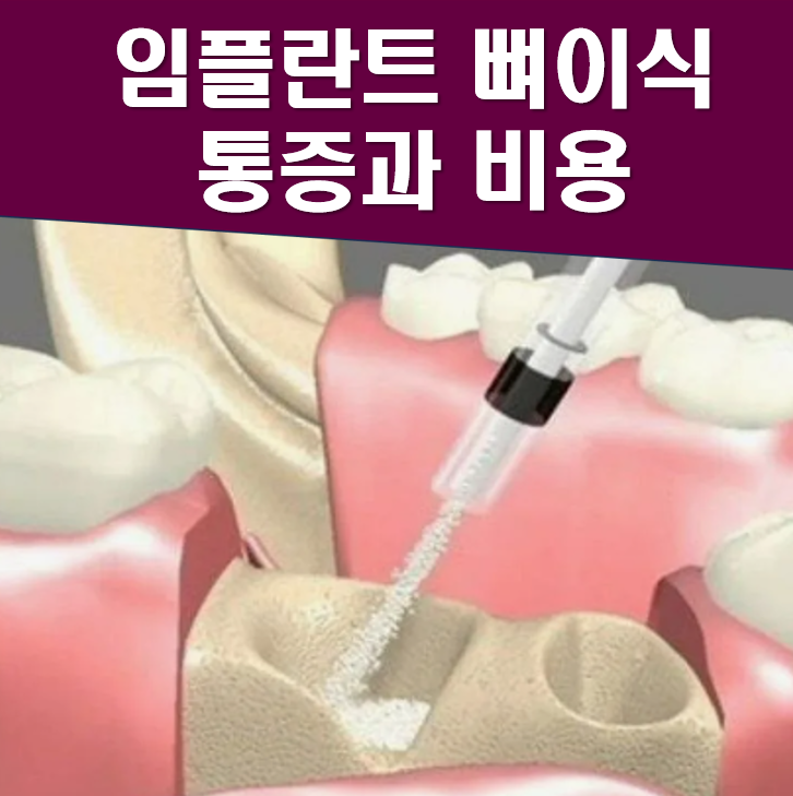 임플란트 뼈이식 통증과 비용