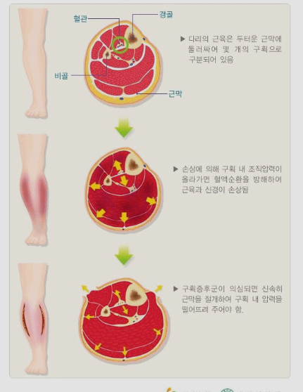 구획증후군