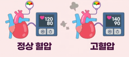 고혈압 진단 기준