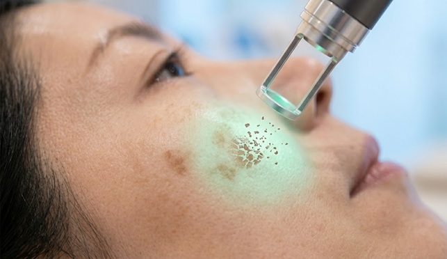 한국 여성의 볼 피부에 피코레이저 시술이 진행되는 중, 극초단파 에너지가 갈색 기미 색소를 잘게 분쇄하는 그래픽 효과가 오버레이된 모습