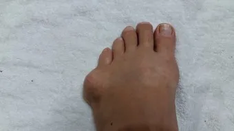 발가락 통풍 증상 및 대처방법_22