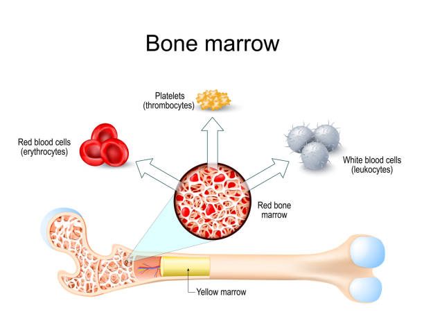 골수증식성 질환 증상