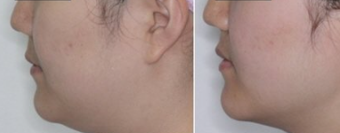 이중턱 지방흡입