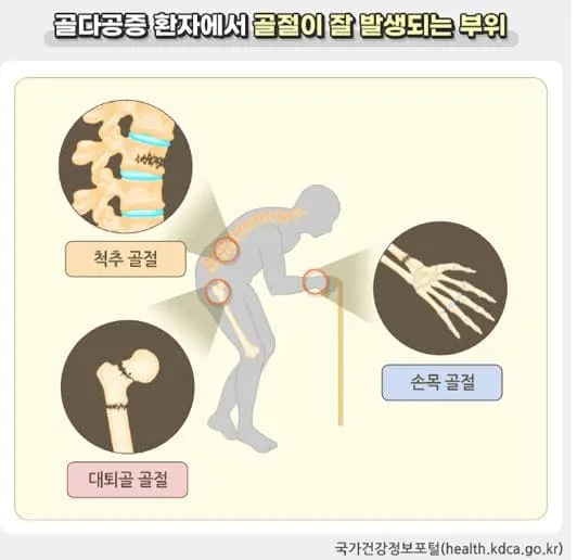 골절이 발생되는 부위