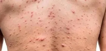 엠폭스 증상 예방접종 대처법 치료방법_18