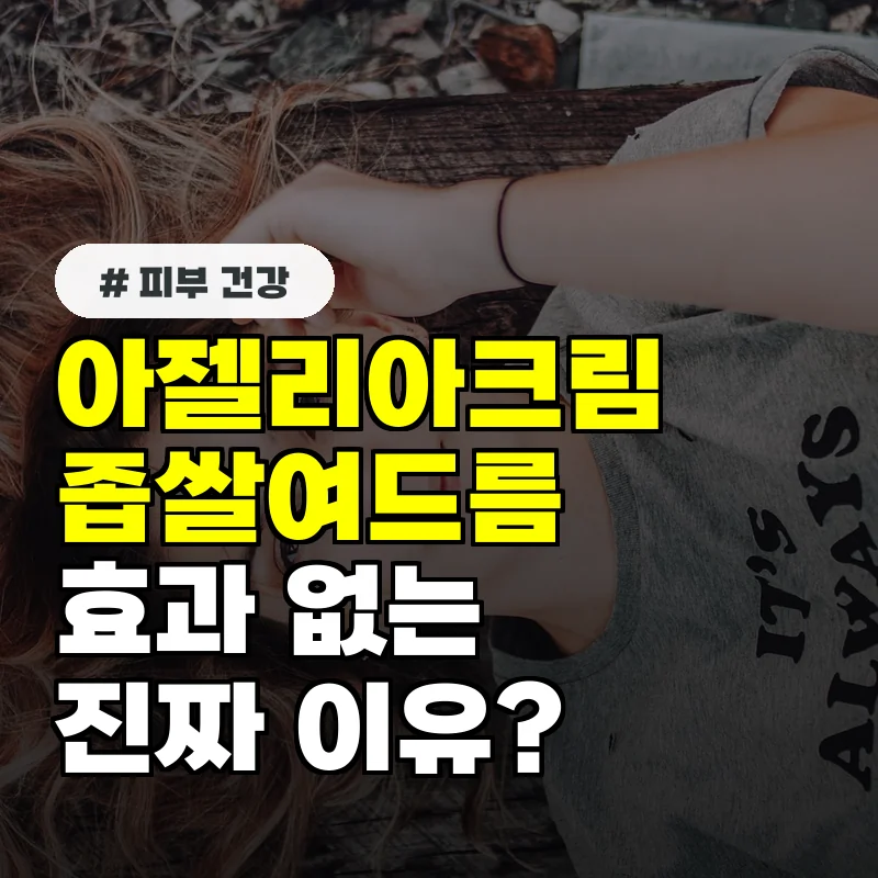 좁쌀여드름에 아젤리아크림 발라도 효과 없는 이유 부작용 피하는 사용법