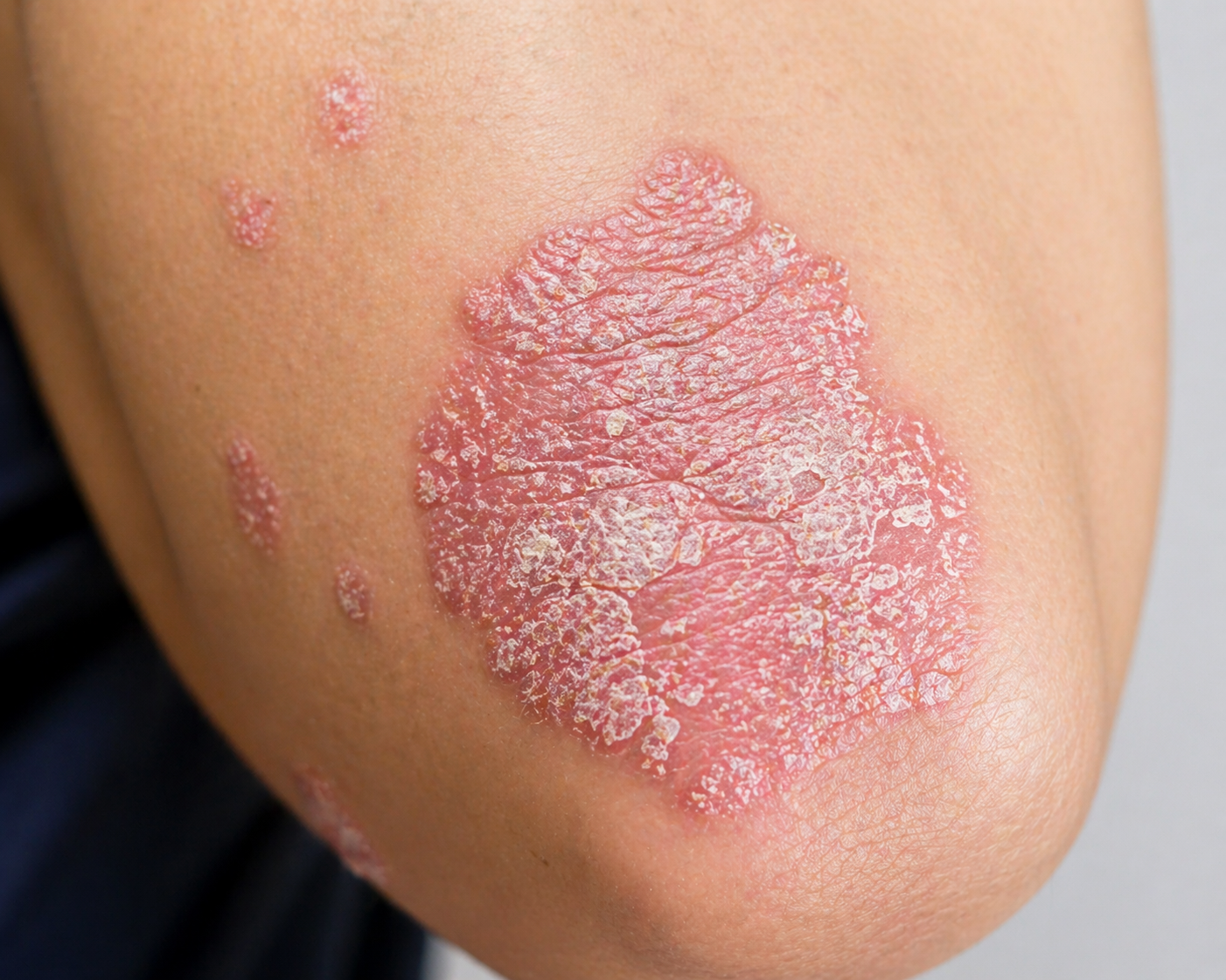 피부건선 증상.원인.치료