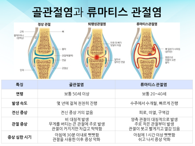 골관절염과 류마티스 관절염