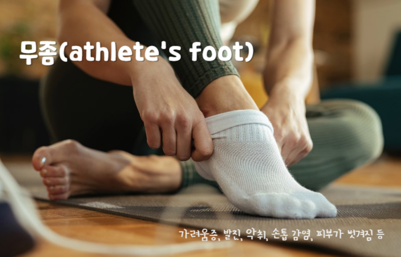 무좀(athlete's foot)
무좀의 주요 증상 : 가려움증, 발진, 악취, 손톱 감염, 피부가 벗겨짐 등