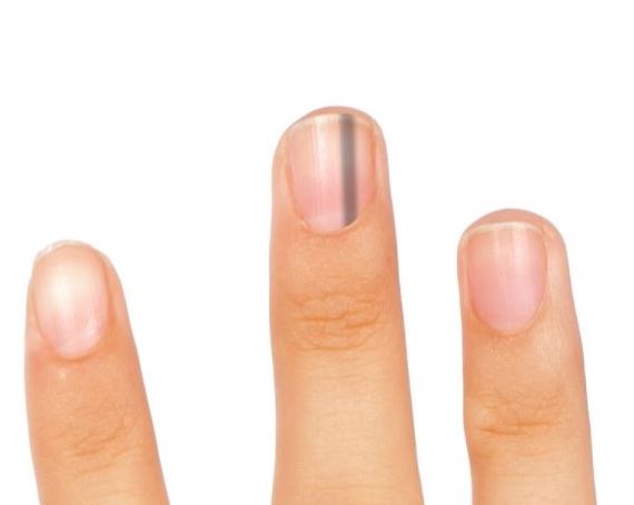 손톱 검은줄 자가진단법