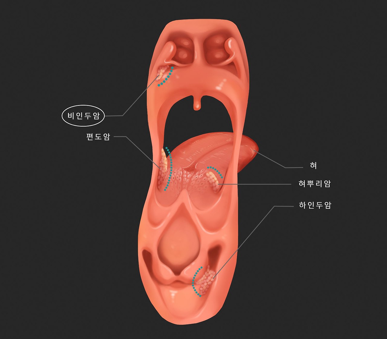 (비인두암)