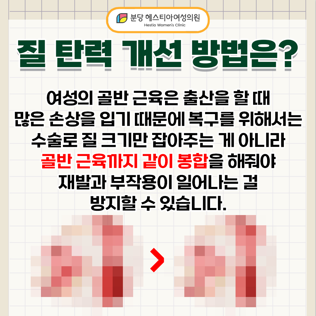 구미동 산부인과 여성의 질 질 탄력 개선 질 탄력 개선 어떻게 하나요?
