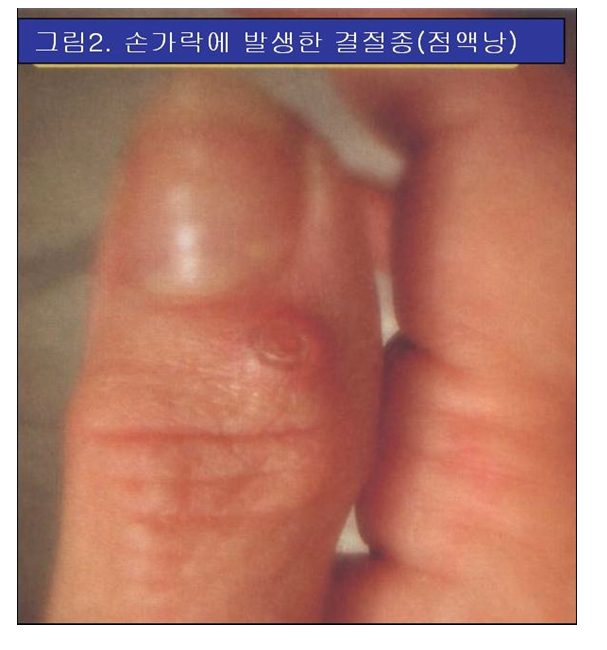 결절종