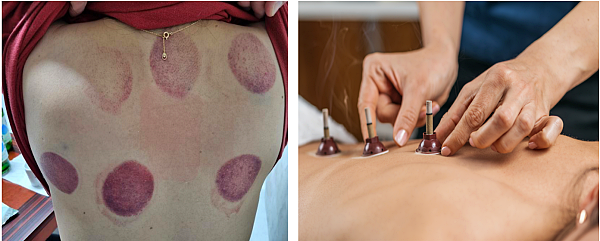 한의원에서의 담치료, 부황, 뜸