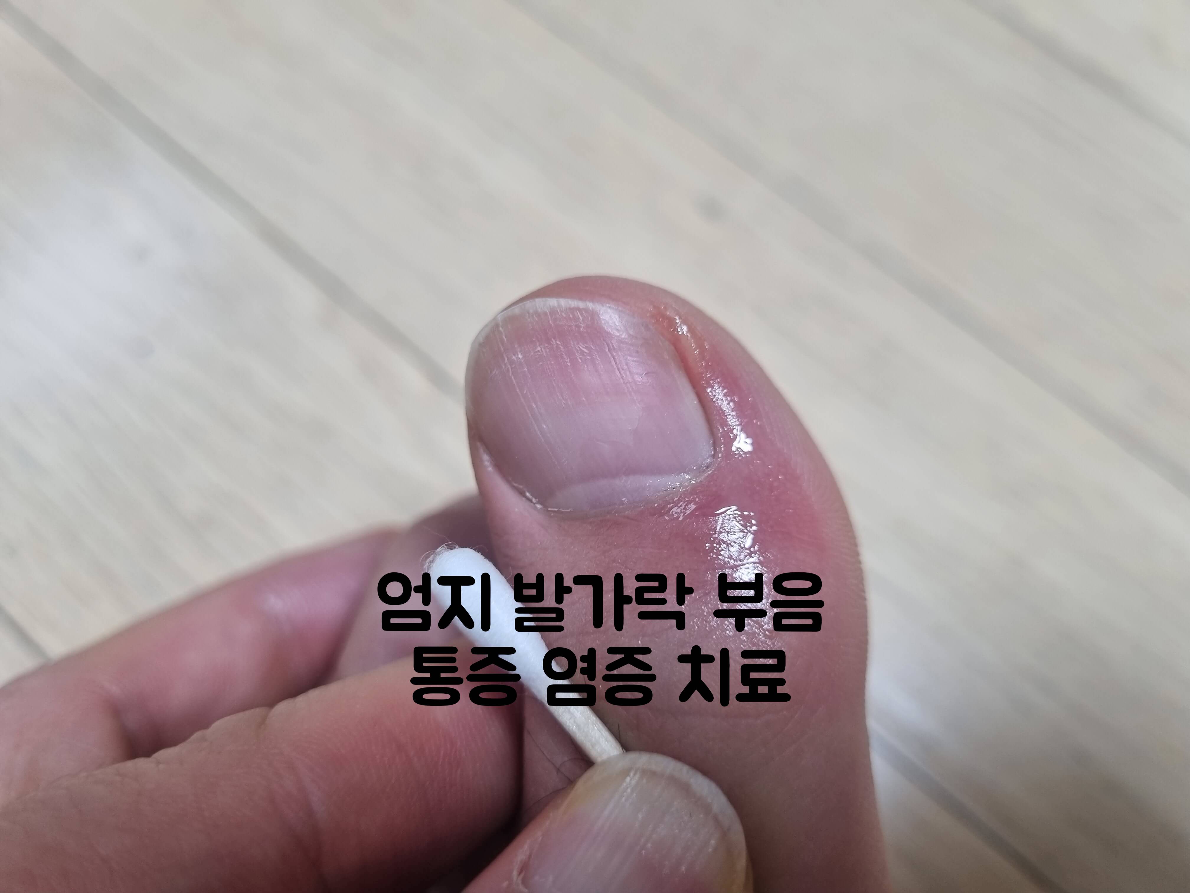 엄지 발가락 부음