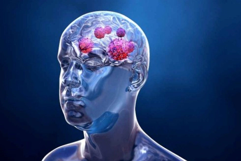 뇌암 초기증상 치료방법 및 김정화 남편 뇌암 사연