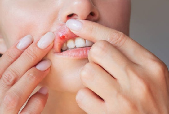 구내염의 원인과 증상, 치료와 예방 방법.