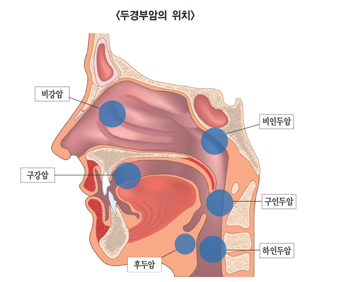 두경부암 전조증상과 치료 전략 관련 이미지