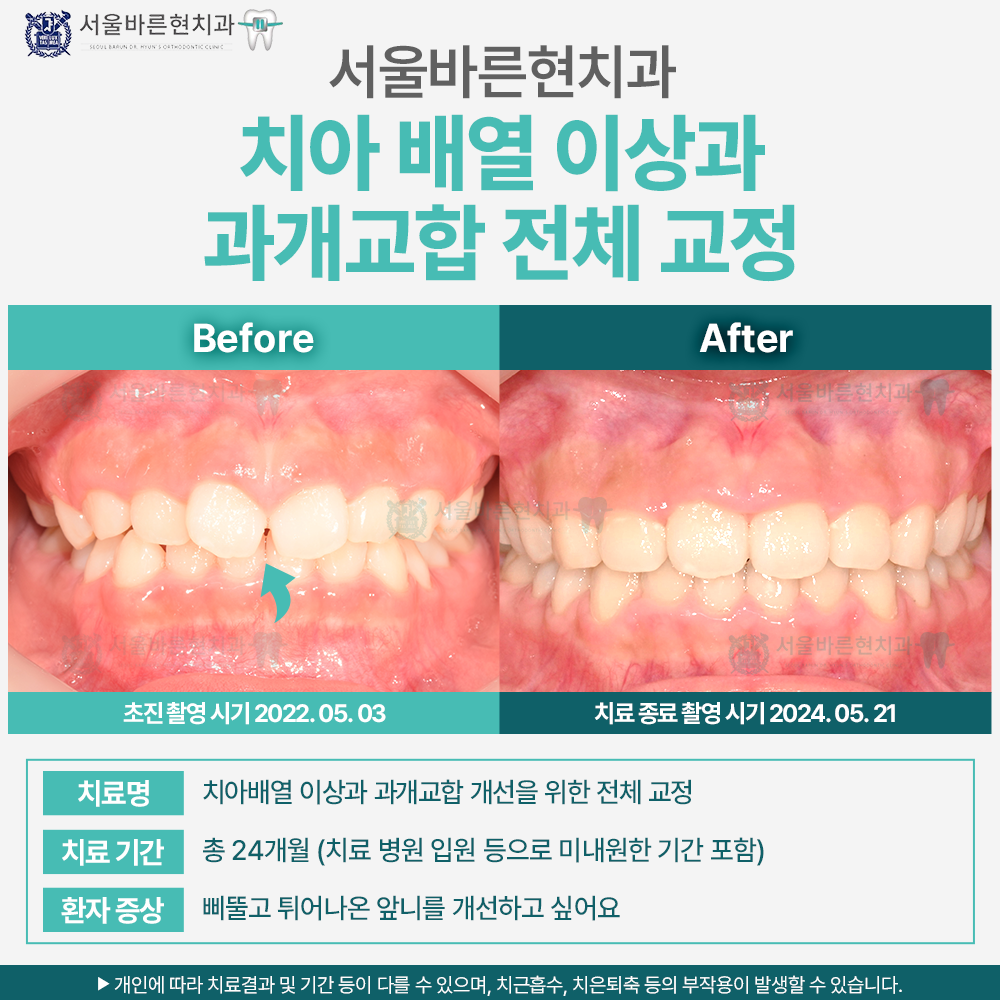 부산치아교정