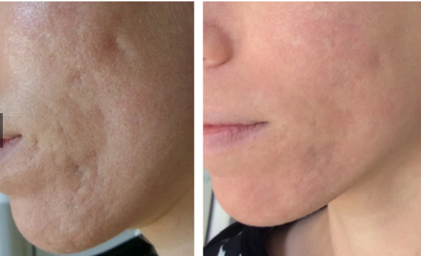 여드름 자국 레이저 후기