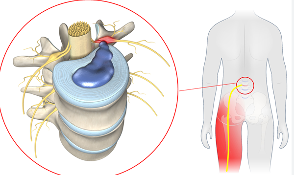 허리디스크 증상