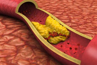 콜레스테롤이 높은 이유