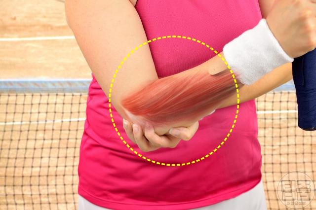 팔꿈치 통증 골프엘보 테니스엘보