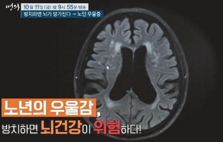 노인우울증뇌상태