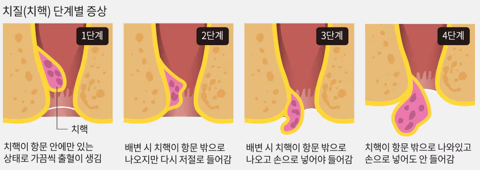 항문이 따가워요! 치질 연고(항문 가려움 약)로 가라앉히는 방법