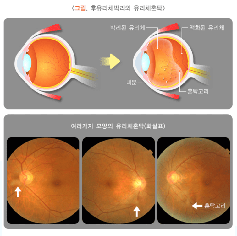 비문증 치료방법 원인 좋은 음식
