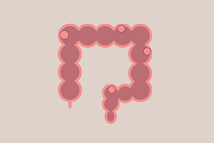 대장에-용종이-생긴-모습