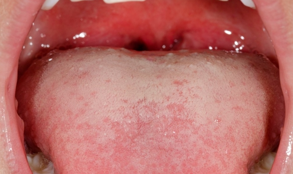 백태-입이헐었을때