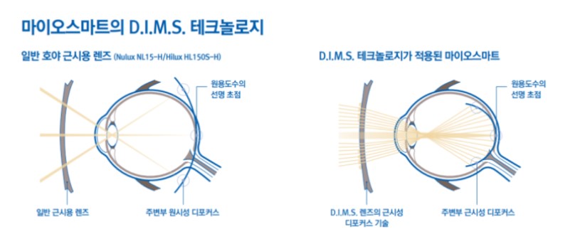 호야 마이오스마트렌즈 원리