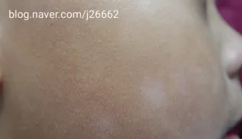 얼굴 버짐 증상 없애는 실전 방법 5가지 및 관리요령_21